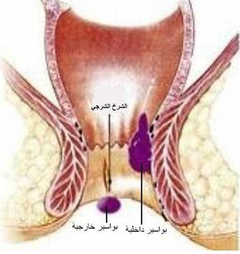 علاج الشرخ الداخلي - كيف اشفى من الشرخ الداخلي 1281