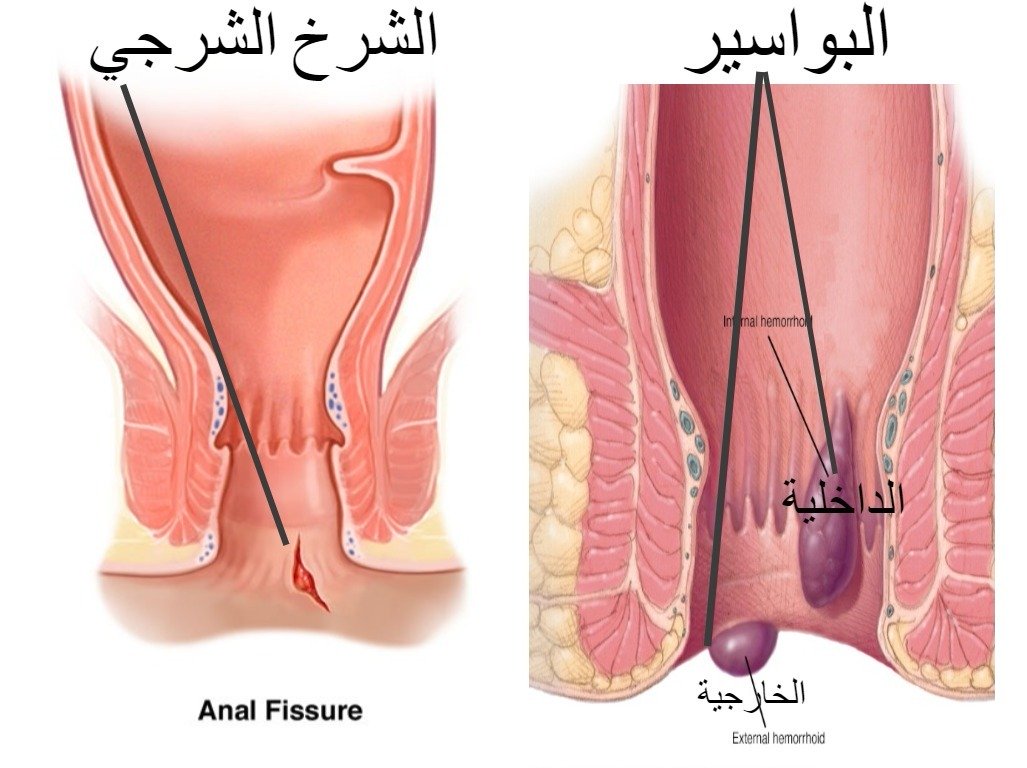 علاج شرخ البواسير - القضاء على الشق الشرجي بالمنزل 1521