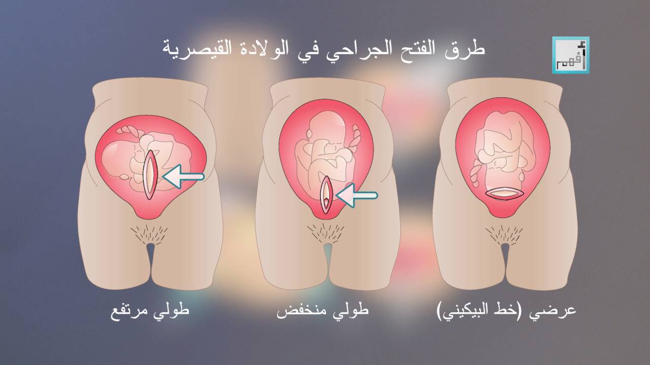 الولادة القيصرية بالصور - صور لمراحل الولادة القيصرية 1406 6