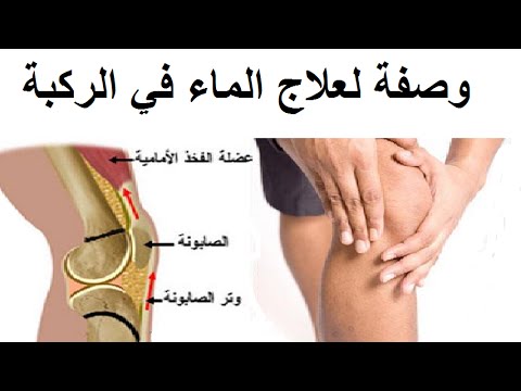 التخلص من ماء الركبه - علاج سريع وفعال لعلاج الم المفاصل 1497 3