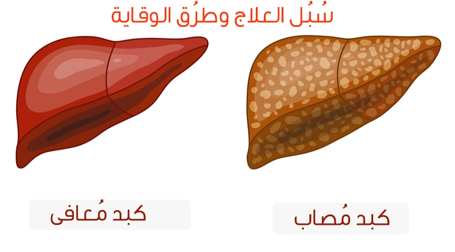 ملهاش علاج - علاج الدهون على الكبد 3749