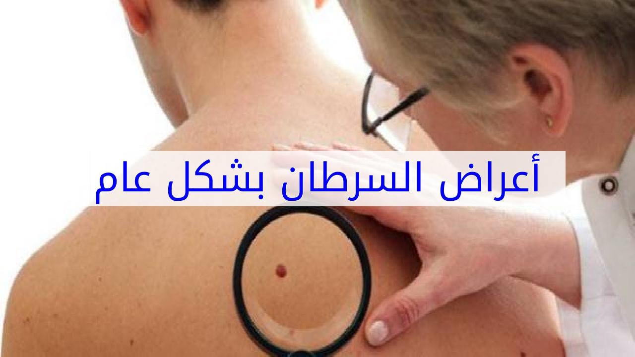 اعراض مرض السرطان بشكل عام - مرض السرطان واعراضه 803