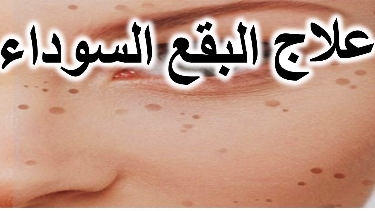 علاج البقع السوداء - حل لمشكلة البثور السوداء 933 3