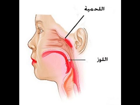 علاج لحمية الانف بدون جراحه - حل لحمية الانف بطرق طبيعية 946 1