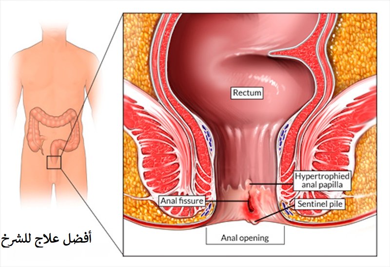 علاج الشرخ الداخلي - كيف اشفى من الشرخ الداخلي 1281 1