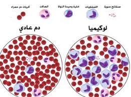 نسبة صفائح الدم الطبيعية , ما هى صفائح الدم