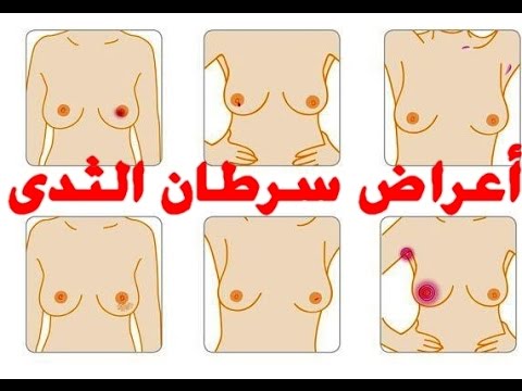 اعراض ورم الثدي الخبيث - اعراض سرطان الثدي 1132