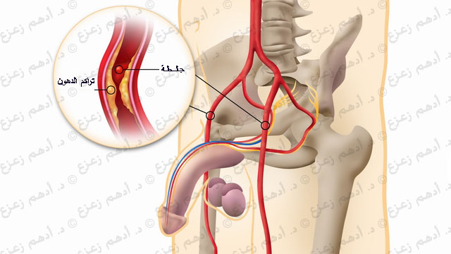 علاج التسرب الوريدى بالاعشاب-اللعشاب الطب البديل 986 1