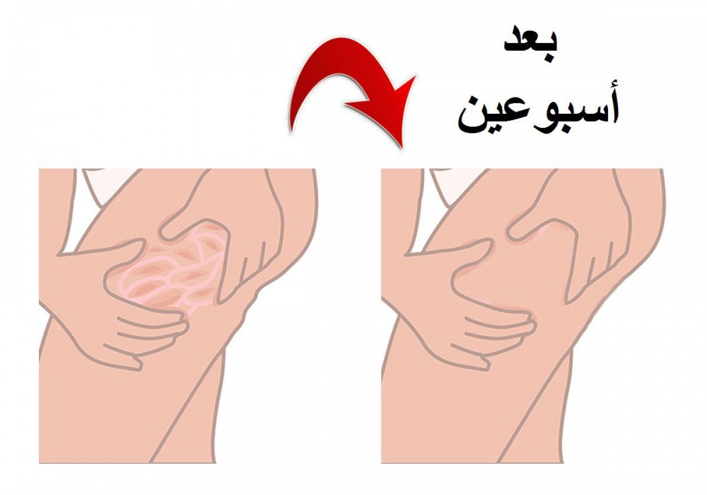 ما هو السيلوليت - ترهلات الجلد بعد التخسيس 867 1