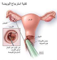 علامات نزول البويضة بالصور-من المعلومات الطبيه 1599 1