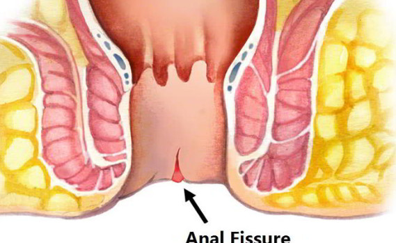 علاج شرخ البواسير - القضاء على الشق الشرجي بالمنزل 1521 2