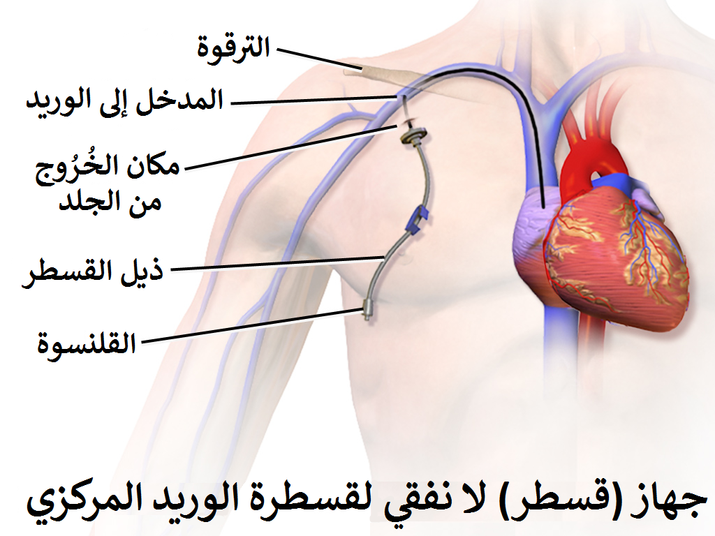 ما هي عملية القسطرة - اهميتها لعلاج القلب وتشخيص العلاج 3640