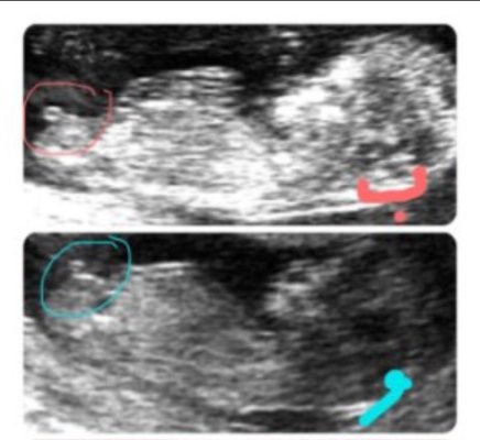 الفرق بين حمل الولد والبنت في السونار - السونار لتحديد نوع الجنين 1480 3