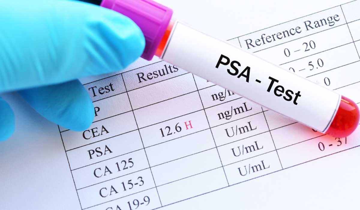 ما هو تحليل Psa - تحليل الPsa واكتشافه لمرض سرطان البروستاتا