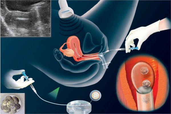 ما هو التلقيح المجهري , عندك مشكلة في الانجاب هنا هتلاقي الحل