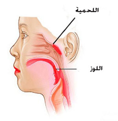 اعراض لحمية الانف عند الاطفال , امراض الجيوب الانفيه اسبابها