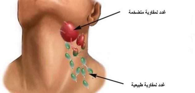 علاج الغدد اللمفاوية , اعراض التهاب الغدد اللمفاوية